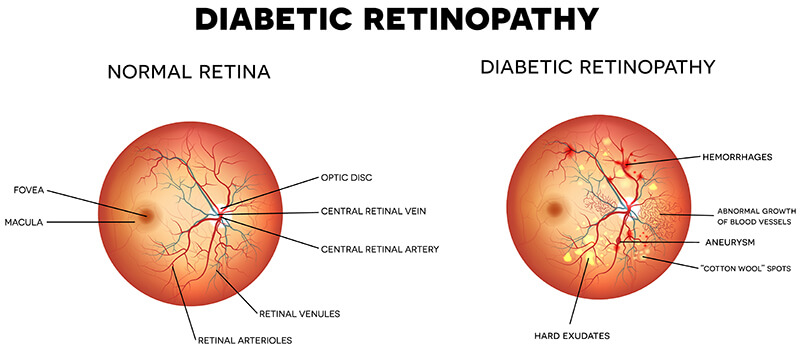 Diabetic Retinopathy