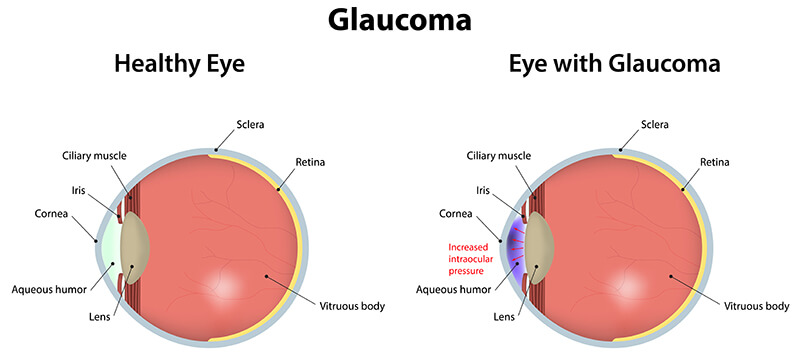 Glaucoma vs Healthy Eye Diagram