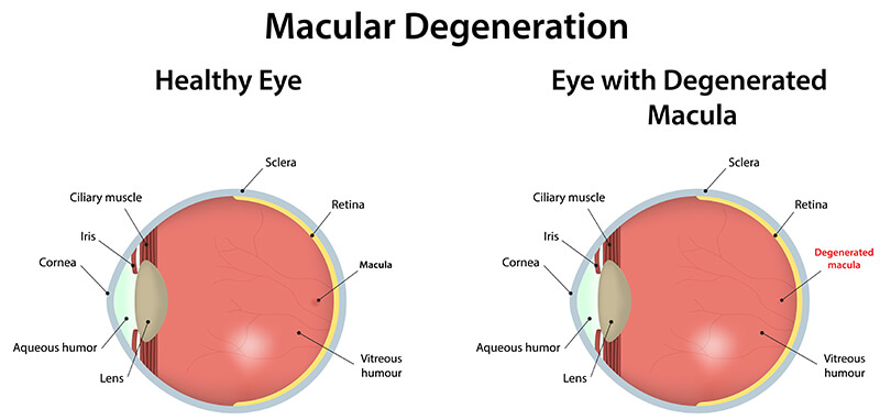 Diagram of Healthy Eye vs. Eye With Degenerated Macula