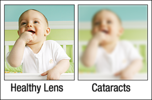 Healthy Lens vs. Cataracts