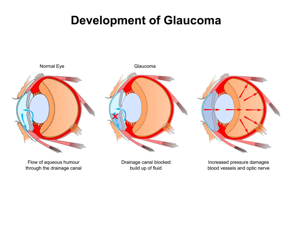 Development of Glaucoma