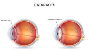 anatomical view of cataracts